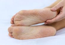 Treating Cracked Skin on the Foot